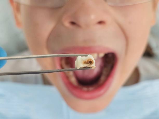 Best Emergency Dentist for Knocked-Out Tooth in Tahoka, TX